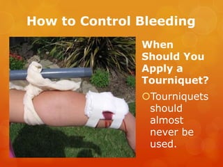 How to Control Bleeding
When
Should You
Apply a
Tourniquet?
Tourniquets
should
almost
never be
used.
 
