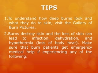 TIPS
1.To understand how deep burns look and
what they do to skin, visit the Gallery of
Burn Pictures.
2.Burns destroy skin and the loss of skin can
lead to infection, dehydration, and
hypothermia (loss of body heat). Make
sure that burn patients get emergency
medical help if experiencing any of the
following:
 