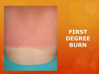 FIRST
DEGREE
BURN
 