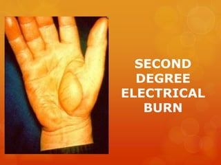 SECOND
DEGREE
ELECTRICAL
BURN
 