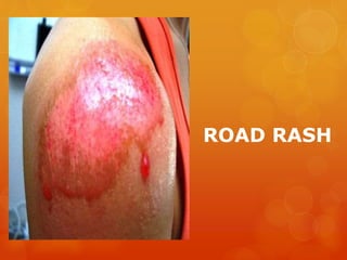 ROAD RASH
 