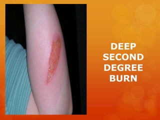 DEEP
SECOND
DEGREE
BURN
 