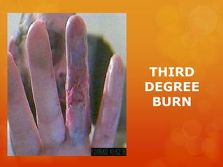 THIRD
DEGREE
BURN
 
