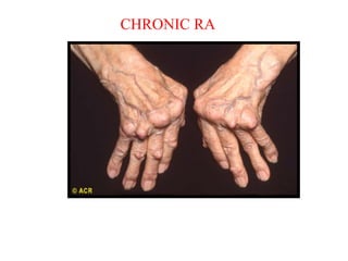 Deviazione ulnare e sublussazione delle articolazioni
metacarpofalangee con tumefazione, noduli reumatoidi.
Spesso concomita atrofia muscolare della muscolatura dorsale.
CHRONIC RA
 
