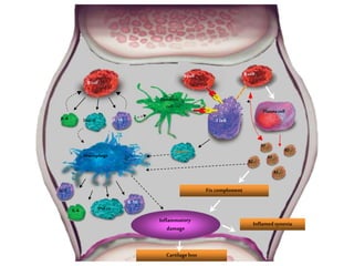 Cartilageloss
IL-6
B cell
T cell
Macrophage
Dendritic
cell
IL-10TNF-a
TNF-a
IL-10
RF
Fix complement
Inflamed synovia
TNF-a
B cell
IL-6
B cell
Plasma cell
RF
RF
RF
RF
IL-1
 