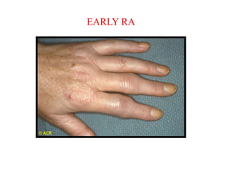Artrite con tumefazione fusiforme delle articolazioni
interfalange prossimali (IFP) tipica nell’artrite reumatoide
EARLY RA
 