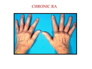 Tumefazione e sublussazioni volari delle articolazioni
metacarpofalangee
CHRONIC RA
 