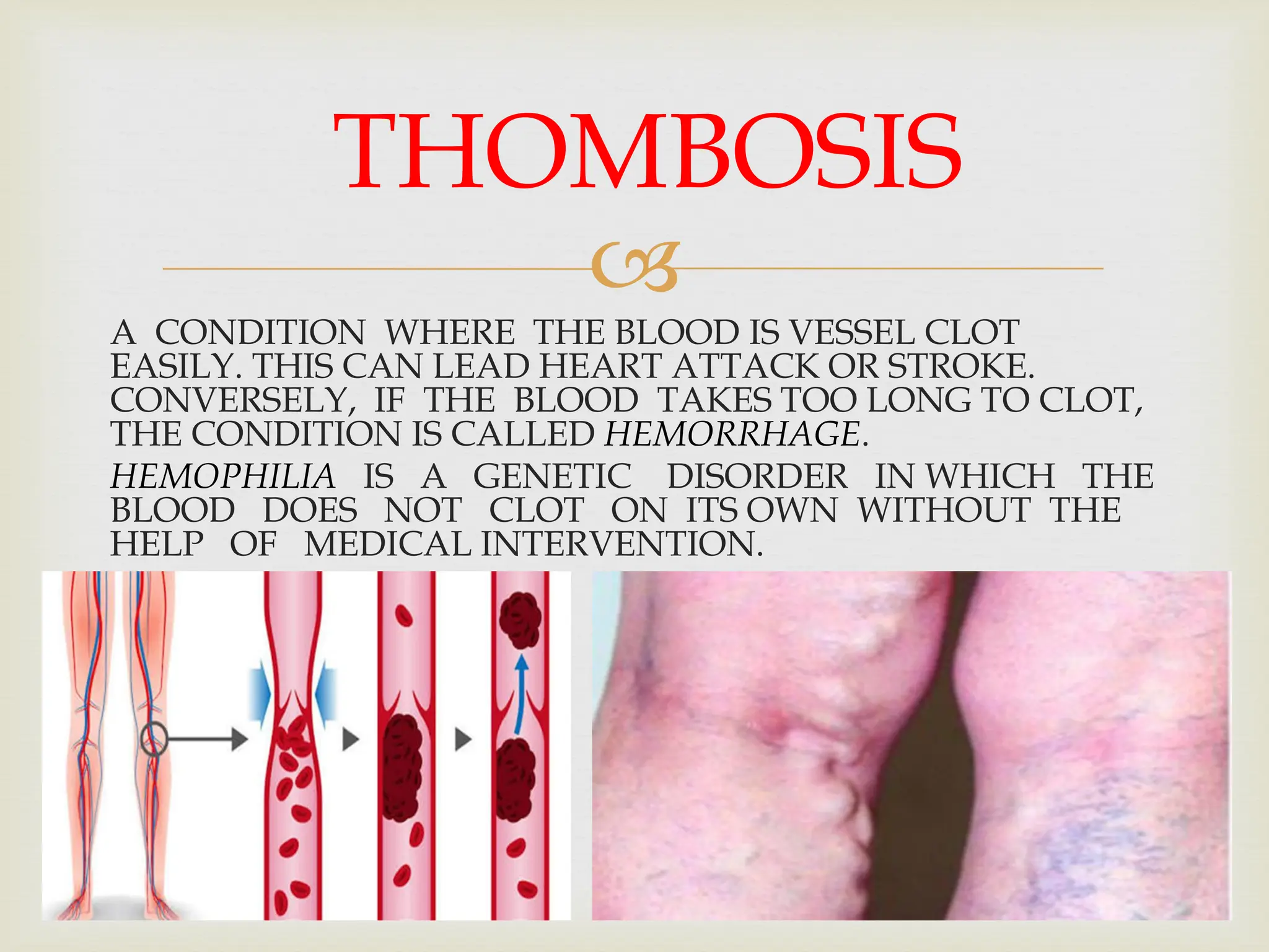 
A CONDITION WHERE THE BLOOD IS VESSEL CLOT
EASILY. THIS CAN LEAD HEART ATTACK OR STROKE.
CONVERSELY, IF THE BLOOD TAKES TOO LONG TO CLOT,
THE CONDITION IS CALLED HEMORRHAGE.
HEMOPHILIA IS A GENETIC DISORDER IN WHICH THE
BLOOD DOES NOT CLOT ON ITS OWN WITHOUT THE
HELP OF MEDICAL INTERVENTION.
THOMBOSIS
 