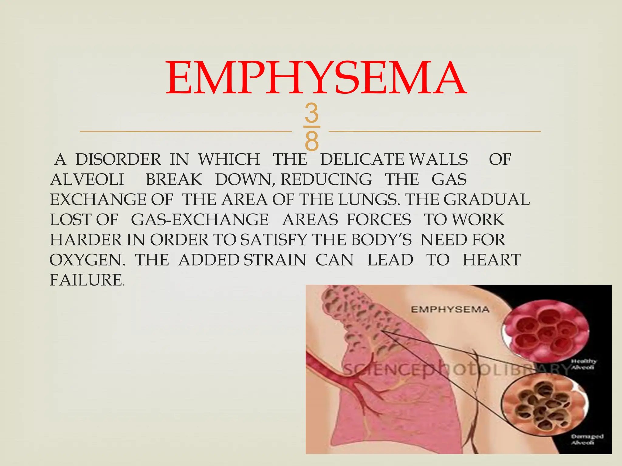 
A DISORDER IN WHICH THE DELICATE WALLS OF
ALVEOLI BREAK DOWN, REDUCING THE GAS
EXCHANGE OF THE AREA OF THE LUNGS. THE GRADUAL
LOST OF GAS-EXCHANGE AREAS FORCES TO WORK
HARDER IN ORDER TO SATISFY THE BODY’S NEED FOR
OXYGEN. THE ADDED STRAIN CAN LEAD TO HEART
FAILURE.
EMPHYSEMA
 