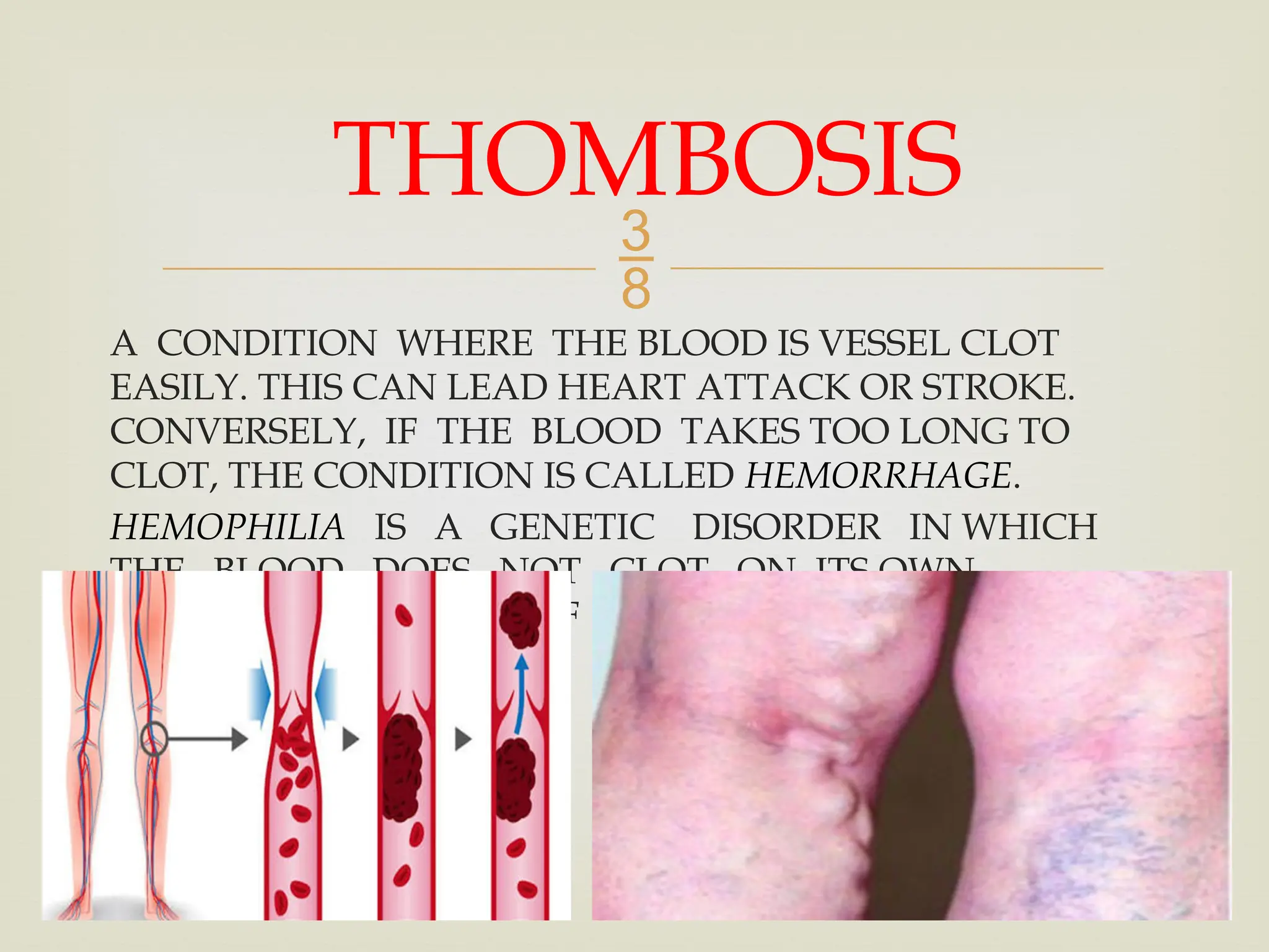 
A CONDITION WHERE THE BLOOD IS VESSEL CLOT
EASILY. THIS CAN LEAD HEART ATTACK OR STROKE.
CONVERSELY, IF THE BLOOD TAKES TOO LONG TO
CLOT, THE CONDITION IS CALLED HEMORRHAGE.
HEMOPHILIA IS A GENETIC DISORDER IN WHICH
THE BLOOD DOES NOT CLOT ON ITS OWN
WITHOUT THE HELP OF MEDICAL INTERVENTION.
THOMBOSIS
 