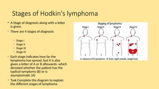 Stages of Hodkin's lymphoma
• A Stage of diagnosis along with a letter
is given.
• There are 4 stages of diagnosis
• Stage I
• Stage II
• Stage III
• Stage IV
• Each stage indicates how far the
lymphoma has spread, but it is also
given a letter of A or B aftewards- which
denoted whether the patient has the
typlical symptoms (B) or is
asymptomatic (A)
• Task Complete the diagram to explain
the different stages of lymphoma
 