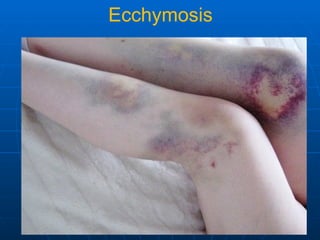LESSON 4-DISORDERS OF BLOOD AND LYMPH CIRCULATION.ppt