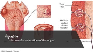 Ageusia
• the loss of taste functions of the tongue
 