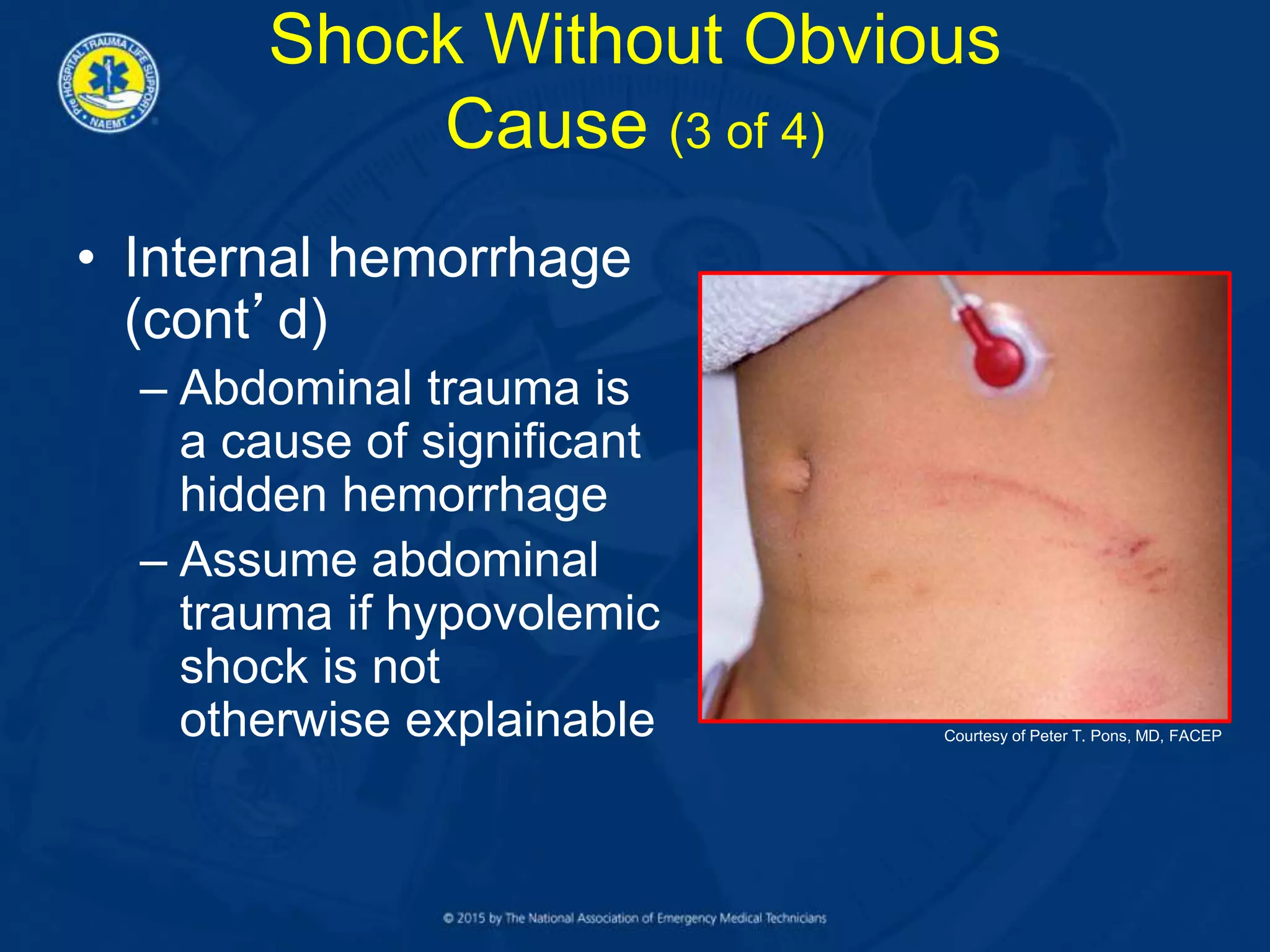 • Internal hemorrhage
(cont’d)
– Abdominal trauma is
a cause of significant
hidden hemorrhage
– Assume abdominal
trauma if hypovolemic
shock is not
otherwise explainable
Shock Without Obvious
Cause (3 of 4)
Courtesy of Peter T. Pons, MD, FACEP
 