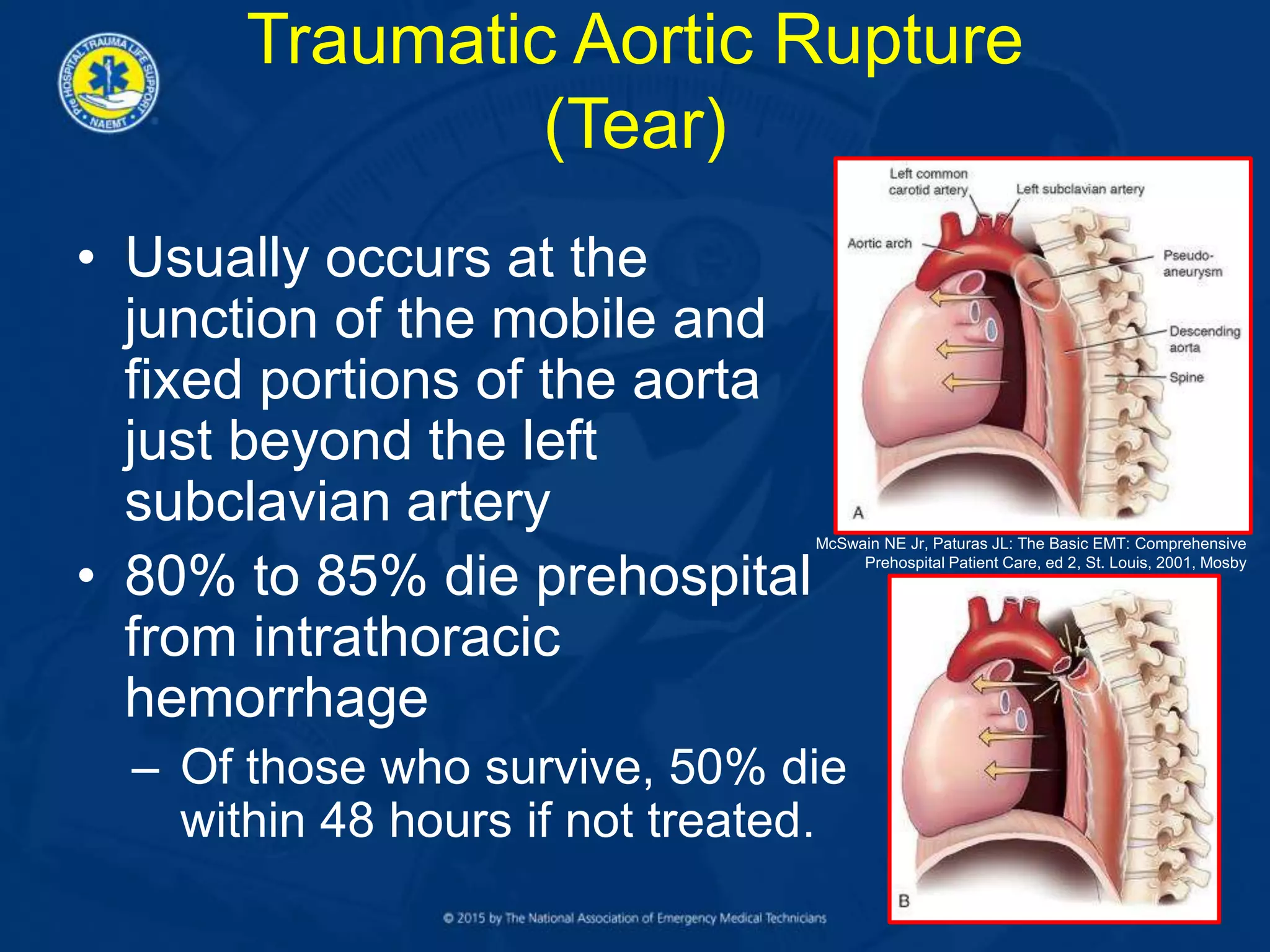 Traumatic Aortic Rupture
(Tear)
• Usually occurs at the
junction of the mobile and
fixed portions of the aorta
just beyond the left
subclavian artery
• 80% to 85% die prehospital
from intrathoracic
hemorrhage
– Of those who survive, 50% die
within 48 hours if not treated.
McSwain NE Jr, Paturas JL: The Basic EMT: Comprehensive
Prehospital Patient Care, ed 2, St. Louis, 2001, Mosby
 