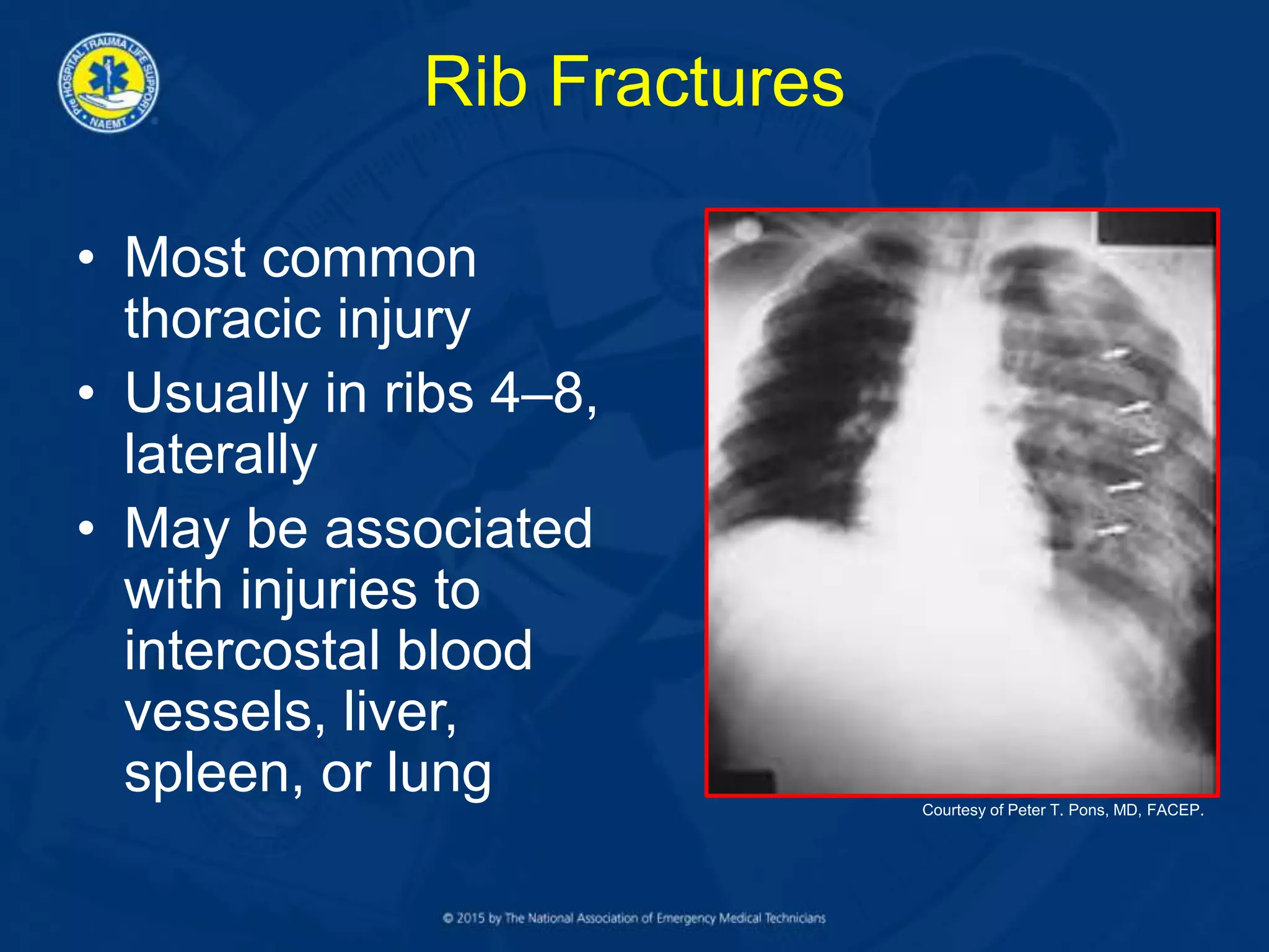 Rib Fractures
• Most common
thoracic injury
• Usually in ribs 4–8,
laterally
• May be associated
with injuries to
intercostal blood
vessels, liver,
spleen, or lung Courtesy of Peter T. Pons, MD, FACEP.
 