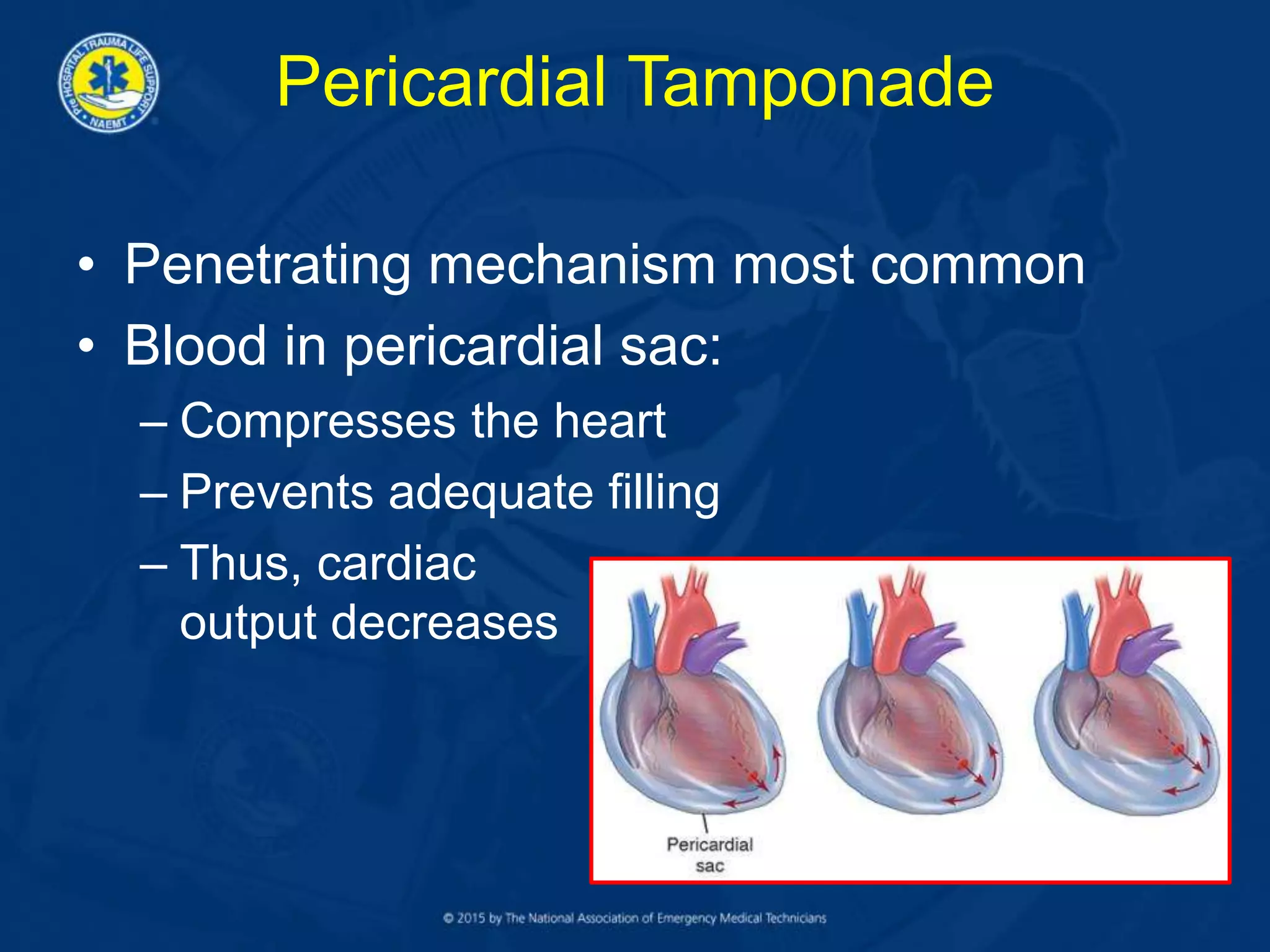 Pericardial Tamponade
• Penetrating mechanism most common
• Blood in pericardial sac:
– Compresses the heart
– Prevents adequate filling
– Thus, cardiac
output decreases
 