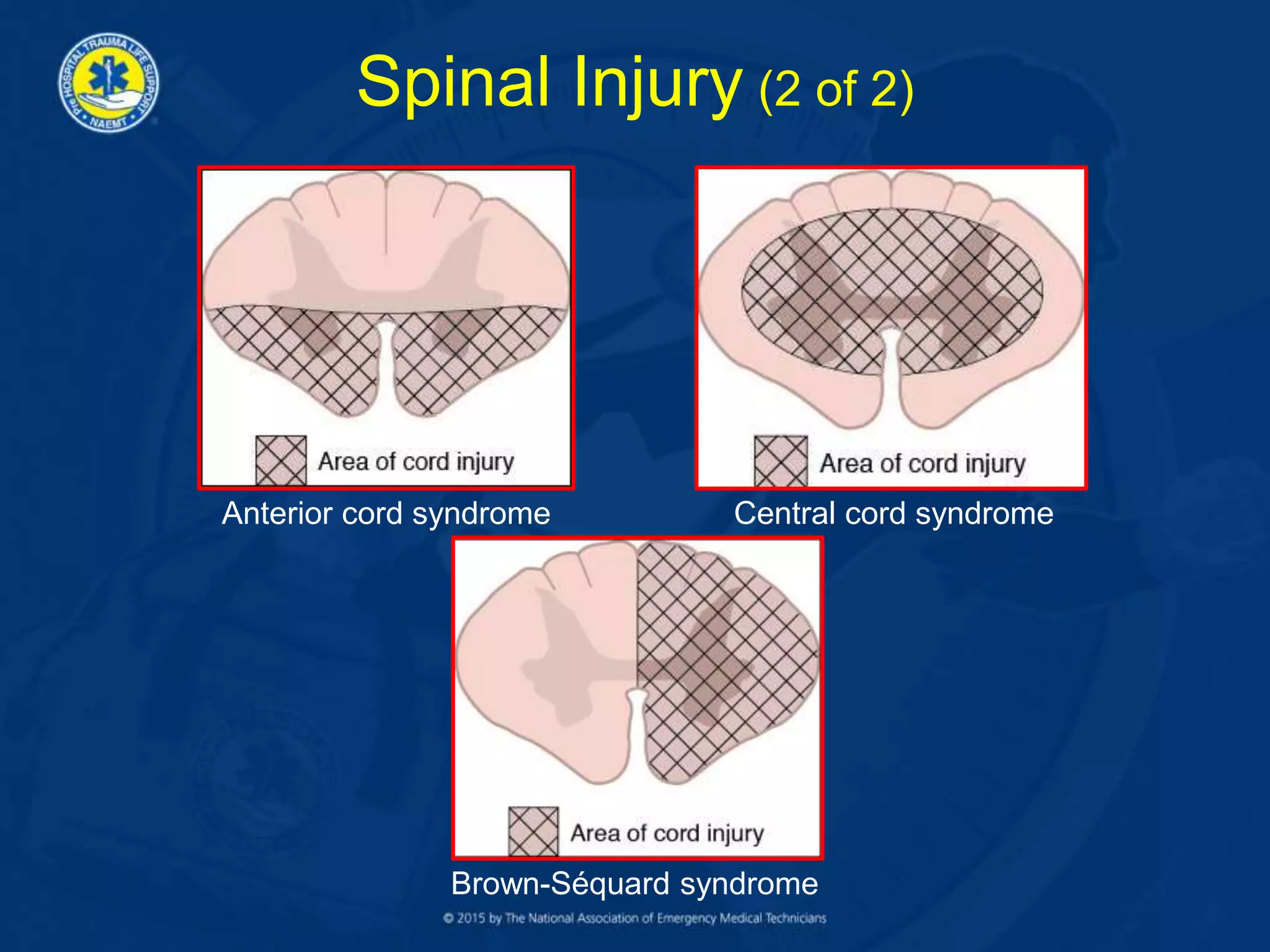 Spinal Injury (2 of 2)
Anterior cord syndrome Central cord syndrome
Brown-Séquard syndrome
 