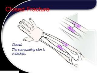 17
Closed:
The surrounding skin is
unbroken.
Closed Fracture
 