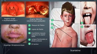 Angine rouge
« erythemateuse »
Angine blanche
«erythemato-pultacée)
Impetigo Streptococcique
Scarlatine
1
2
3
4
1
2
4
3
5
5
Masque de Filatov
Lignes de Pastia
Exanthème maculo-
papuleux en papier
sablé
Langue framboisée en
phase précoce
Et tardive
 