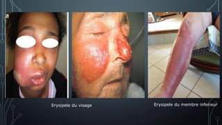 Erysipele du visage Erysipele du membre inferieur
 