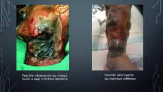 Fasciite nécrosante du visage
Suite a une infection dentaire
Fasciite nécrosante
du membre inférieur
 