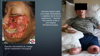 Fasciite nécrosante du visage
Après traitement chirurgical
Homme Ayant subit
une triple amputation
+ ablation de la levre
supérieure : fasciite
necrosante suite a
une angine
Streptococcique.
 