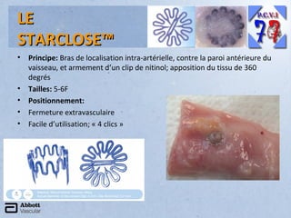 LE
STARCLOSE™
•

•
•
•
•

Principe: Bras de localisation intra-artérielle, contre la paroi antérieure du
vaisseau, et armement d’un clip de nitinol; apposition du tissu de 360
degrés
Tailles: 5-6F
Positionnement:
Fermeture extravasculaire
Facile d’utilisation; « 4 clics »

 