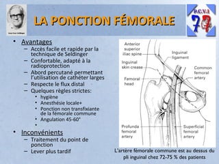LA PONCTION FÉMORALE
• Avantages

– Accès facile et rapide par la
technique de Seldinger
– Confortable, adapté à la
radioprotection
– Abord percutané permettant
l’utilisation de cathéter larges
– Respecte le flux distal
– Quelques règles strictes:
• hygiène
• Anesthésie locale+
• Ponction non transfixiante
de la fémorale commune
• Angulation 45-60°
•

• Inconvénients

– Traitement du point de
ponction
– Lever plus tardif

L’artère fémorale commune est au dessus du
pli inguinal chez 72-75 % des patients

 