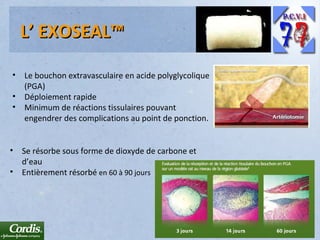 L’ EXOSEAL™
•
•
•

•

Le bouchon extravasculaire en acide polyglycolique
(PGA)
Déploiement rapide
Minimum de réactions tissulaires pouvant
engendrer des complications au point de ponction.

Se résorbe sous forme de dioxyde de carbone et
d’eau
• Entièrement résorbé en 60 à 90 jours

 