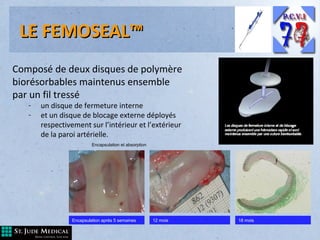 LE FEMOSEAL™
Composé de deux disques de polymère
biorésorbables maintenus ensemble
par un fil tressé
-

un disque de fermeture interne
et un disque de blocage externe déployés
respectivement sur l’intérieur et l’extérieur
de la paroi artérielle.
Encapsulation et absorption

Encapsulation après 5 semaines

12 mois

18 mois

 