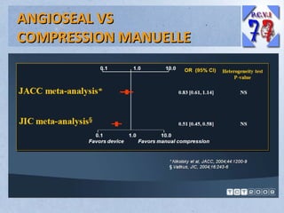 ANGIOSEAL VS
COMPRESSION MANUELLE

 