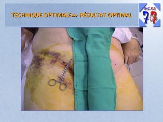 TECHNIQUE OPTIMALE⇒ RÉSULTAT OPTIMAL

 