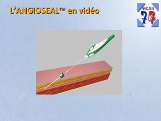 L’ANGIOSEAL™ en vidéo

 