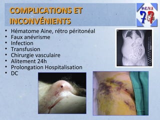 COMPLICATIONS ET
INCONVÉNIENTS
•
•
•
•
•
•
•
•

Hématome Aine, rétro péritonéal
Faux anévrisme
Infection
Transfusion
Chirurgie vasculaire
Alitement 24h
Prolongation Hospitalisation
DC

 