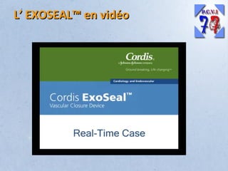 L’ EXOSEAL™ en vidéo

 