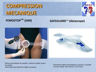COMPRESSION
MECANIQUE
FEMOSTOP™ (SJM)

Dôme pneumatique de pression, ceinture à placer autour
du patient
Manomètre permettant de régler la pression

SAFEGUARD™ (datascope)

Pansement stérile hémostatique à pression controlée
Vol d’air injecté: 40ml (24cm), 7ml (12cm)

 