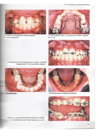 Les traitements orthodontiques précoces 