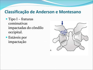 Classificação de Anderson e Montesano
 Tipo I – fraturas
cominutivas
impactadas do côndilo
occipital.
 Estáveis por
impactação
 