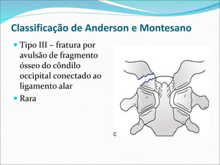 Classificação de Anderson e Montesano
 Tipo III – fratura por
avulsão de fragmento
ósseo do côndilo
occipital conectado ao
ligamento alar
 Rara
 