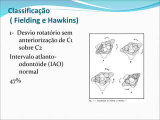 Classificação
( Fielding e Hawkins)
1- Desvio rotatório sem
anteriorização de C1
sobre C2
Intervalo atlanto-
odontóide (IAO)
normal
47%
 