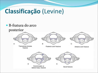 Classificação (Levine)
 B-fratura do arco
posterior
 