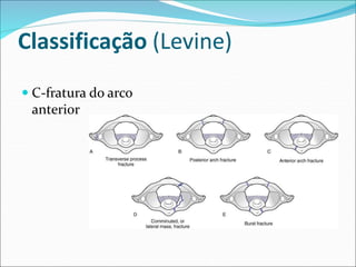 Classificação (Levine)
 C-fratura do arco
anterior
 