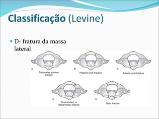 Classificação (Levine)
 D- fratura da massa
lateral
 