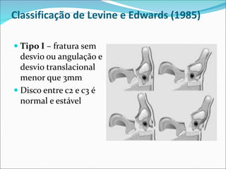 Classificação de Levine e Edwards (1985)
 Tipo I – fratura sem
desvio ou angulação e
desvio translacional
menor que 3mm
 Disco entre c2 e c3 é
normal e estável
 