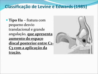 Classificação de Levine e Edwards (1985)
 Tipo IIa – fratura com
pequeno desvio
translacional e grande
angulação, que apresenta
aumento do espaço
discal posterior entre C2-
C3 com a aplicação da
tração.
 