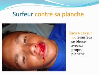 Surfeur contre sa planche
Dans 6 cas sur
10, le surfeur
se blesse
avec sa
propre
planche.
 