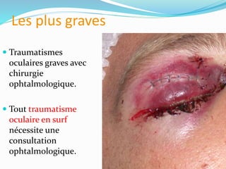 Les plus graves
 Traumatismes
oculaires graves avec
chirurgie
ophtalmologique.
 Tout traumatisme
oculaire en surf
nécessite une
consultation
ophtalmologique.
 