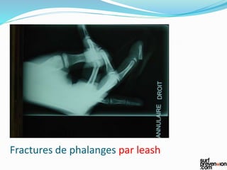 Fractures de phalanges par leash
 