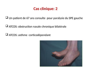 Cas clinique: 2
 Un patient de 67 ans consulte pour paralysie du SPE gauche
 ATCDS: obstruction nasale chronique bilatérale
 ATCDS: asthme corticodépendant
 
